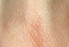 https://upload.wikimedia.org/wikipedia/commons/thumb/1/13/Human_skin_structure.jpg/300px-Human_skin_structure.jpg