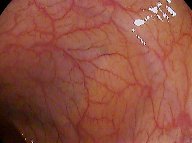 https://upload.wikimedia.org/wikipedia/commons/thumb/0/04/Colonoscopy_splenic_flexure.jpg/220px-Colonoscopy_splenic_flexure.jpg