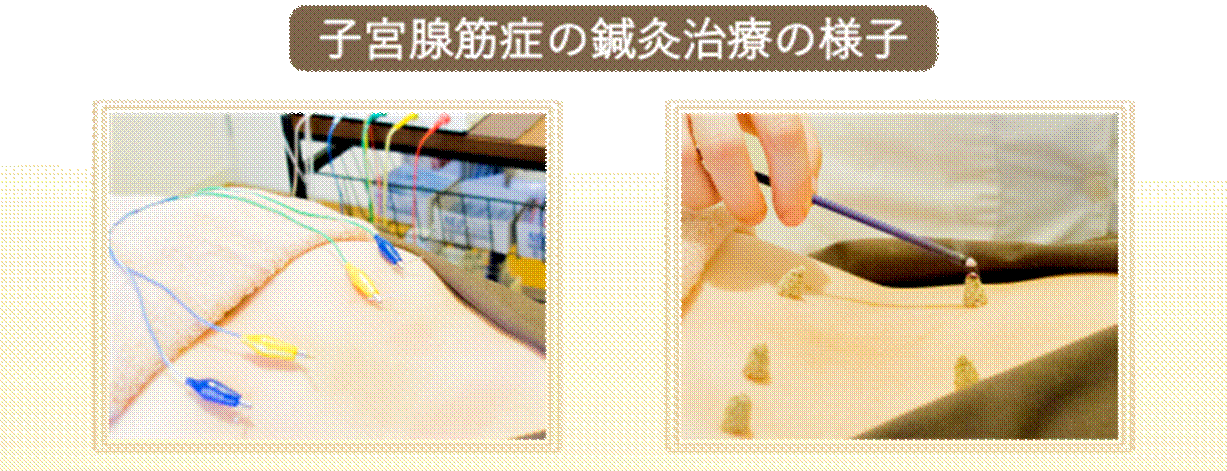子宮腺筋症の鍼灸治療の様子