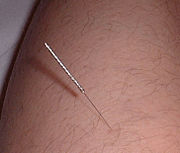 https://upload.wikimedia.org/wikipedia/commons/thumb/e/e2/Acupuncture_ja.jpg/180px-Acupuncture_ja.jpg