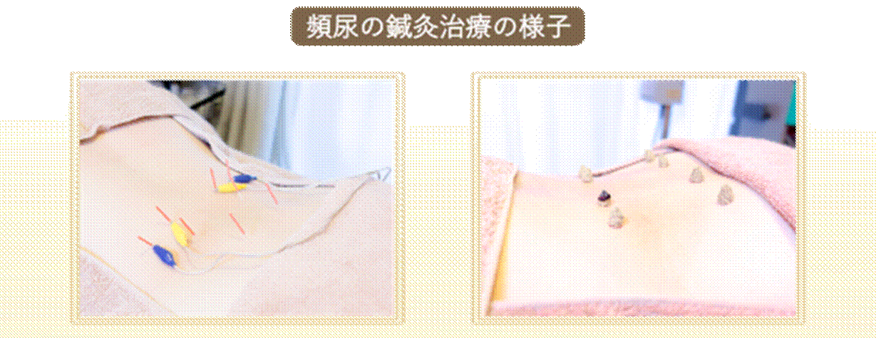 頻尿の鍼灸治療の様子