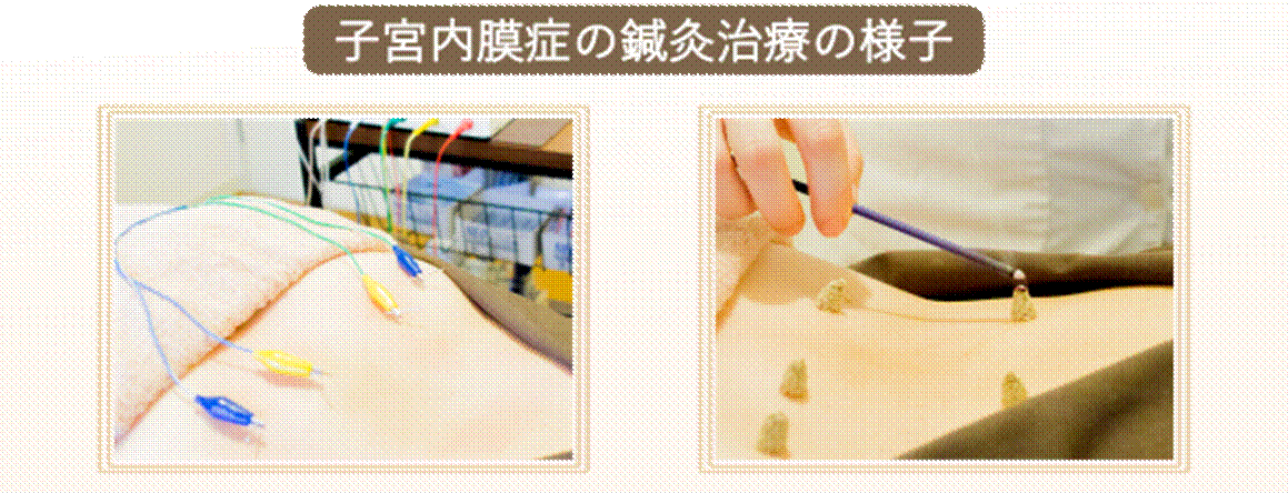 子宮内膜症の鍼灸治療の様子