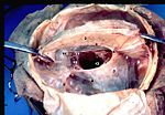 https://upload.wikimedia.org/wikipedia/commons/thumb/e/ea/Human_brain_dura_mater_%28reflections%29_description.JPG/150px-Human_brain_dura_mater_%28reflections%29_description.JPG