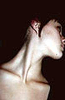 https://upload.wikimedia.org/wikipedia/commons/thumb/5/5c/Young_woman%27s_neck.jpg/78px-Young_woman%27s_neck.jpg