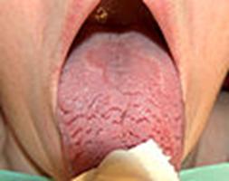 https://upload.wikimedia.org/wikipedia/commons/thumb/9/97/Fissured_geographic_tongue.jpg/120px-Fissured_geographic_tongue.jpg