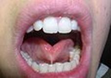 https://upload.wikimedia.org/wikipedia/commons/thumb/2/2f/Frenulum_linguae.jpg/120px-Frenulum_linguae.jpg