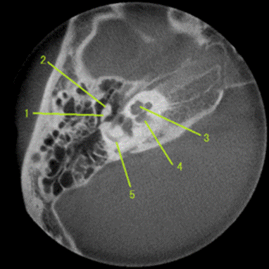 https://upload.wikimedia.org/wikipedia/commons/thumb/3/34/Malleus_and_Incus-Ice_cream_corn_sign.png/270px-Malleus_and_Incus-Ice_cream_corn_sign.png